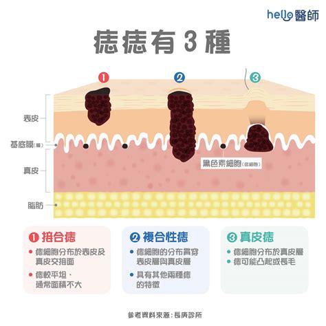 痣 形成